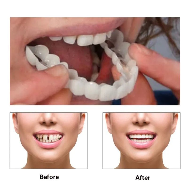 Viral Adjustable Snap-On-Dentures